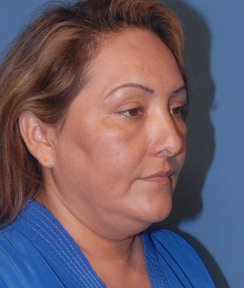 Facelift Before & After