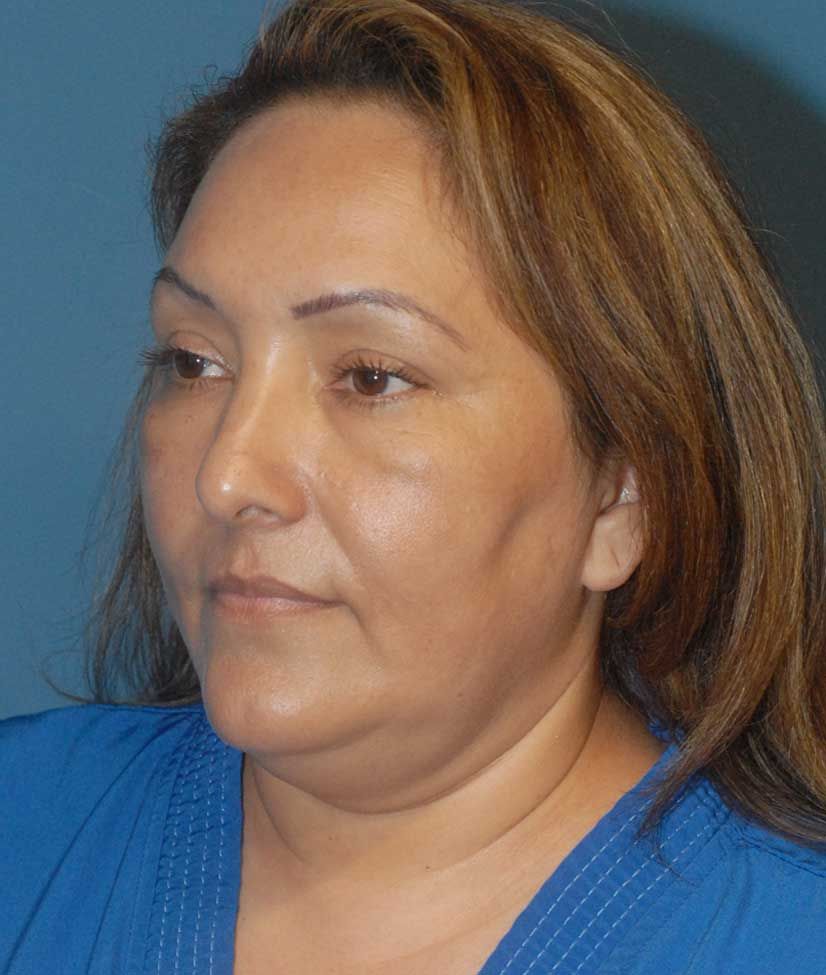 Facelift Before & After