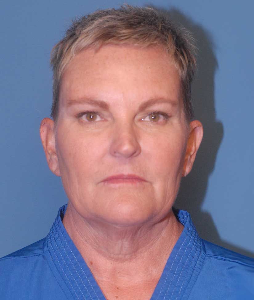 Facelift Before & After