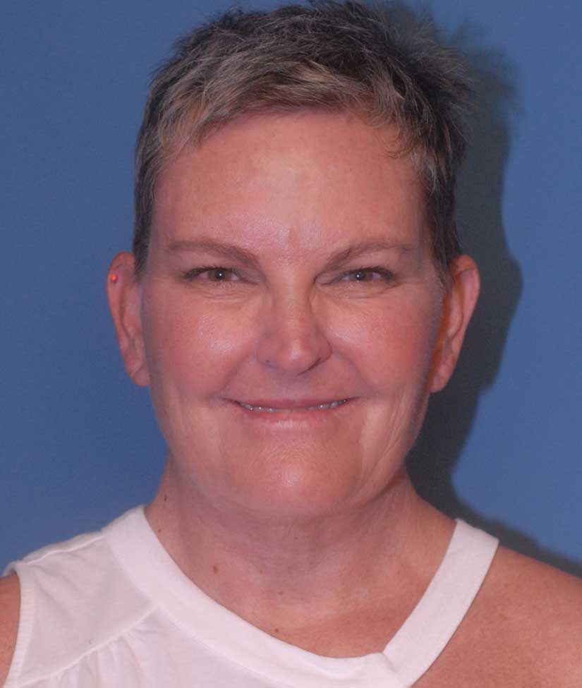 Facelift Before & After