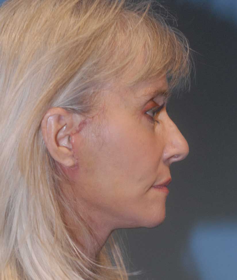 Facelift Before & After