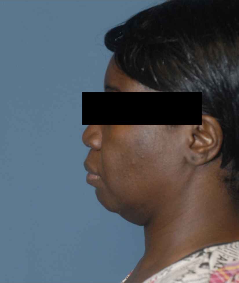 Facelift Before & After