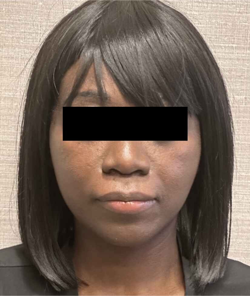 Facelift Before & After