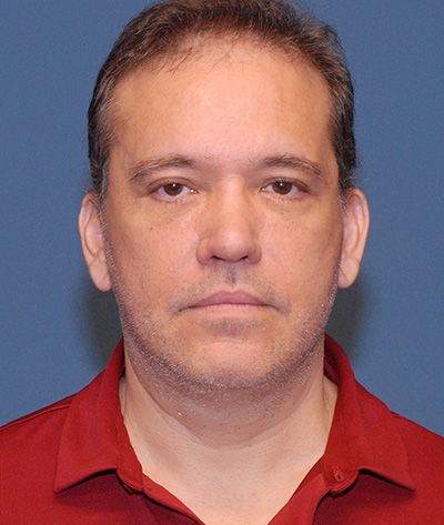 Facelift Before & After