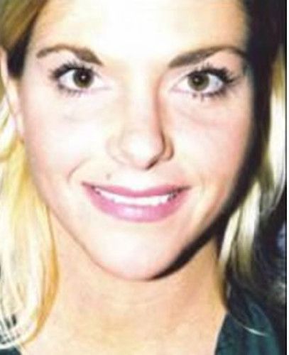 Rhinoplasty Before & After