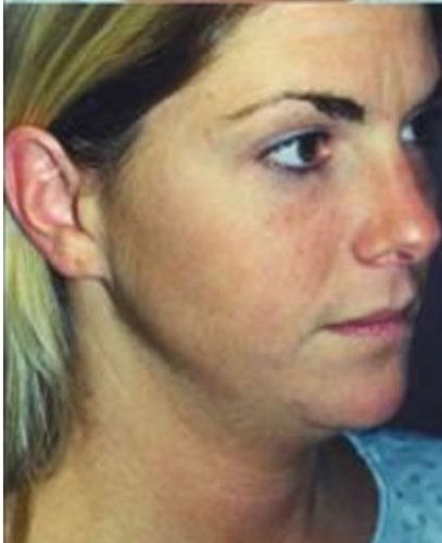 Rhinoplasty Before & After