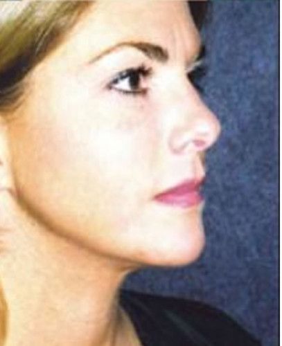 Rhinoplasty Before & After