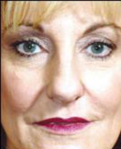 Rhinoplasty Before & After