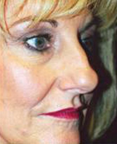 Rhinoplasty Before & After