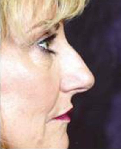 Rhinoplasty Before & After
