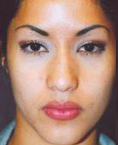 Rhinoplasty Before & After