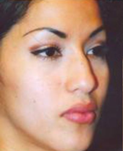 Rhinoplasty Before & After