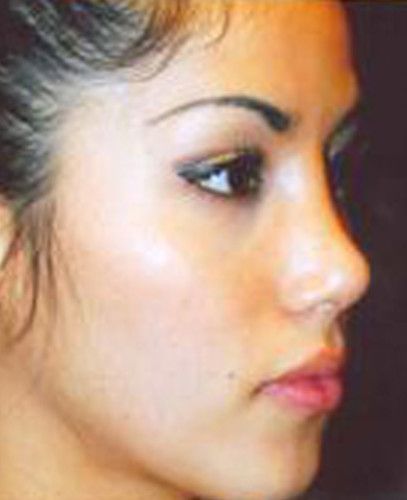 Rhinoplasty Before & After