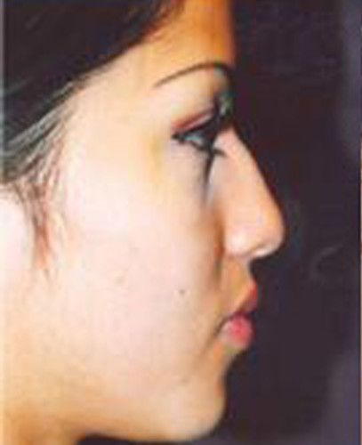 Rhinoplasty Before & After