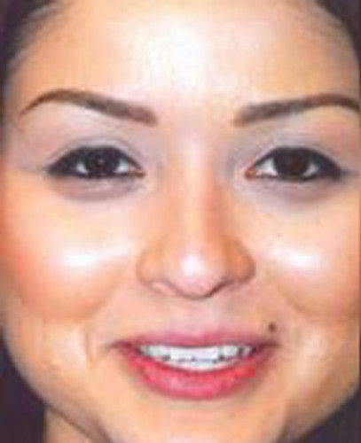 Rhinoplasty Before & After