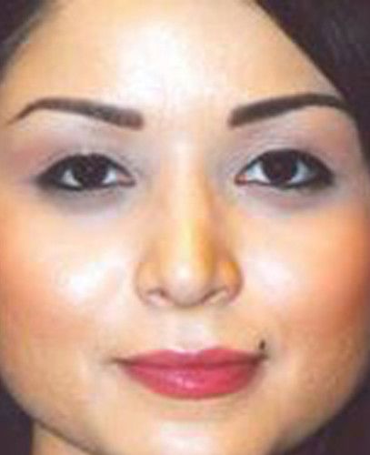 Rhinoplasty Before & After