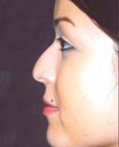 Rhinoplasty Before & After
