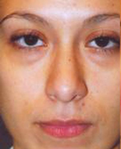Rhinoplasty Before & After