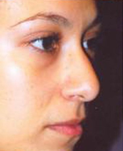 Rhinoplasty Before & After