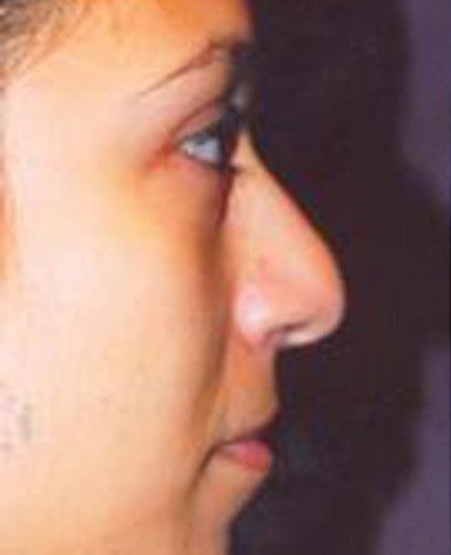 Rhinoplasty Before & After