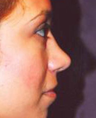 Rhinoplasty Before & After