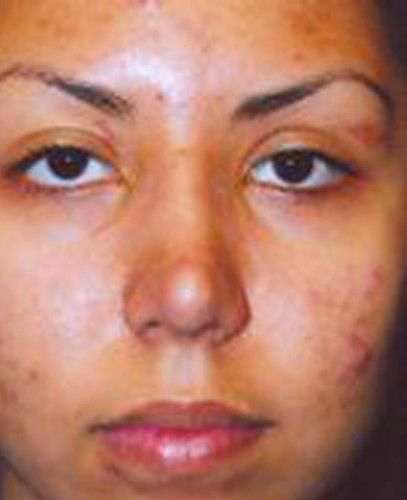 Rhinoplasty Before & After