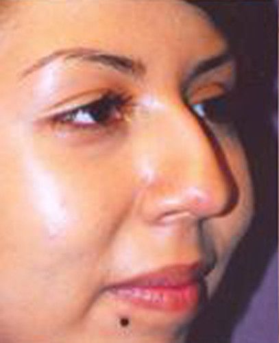 Rhinoplasty Before & After