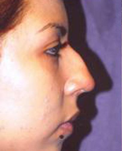 Rhinoplasty Before & After