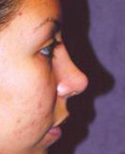 Rhinoplasty Before & After