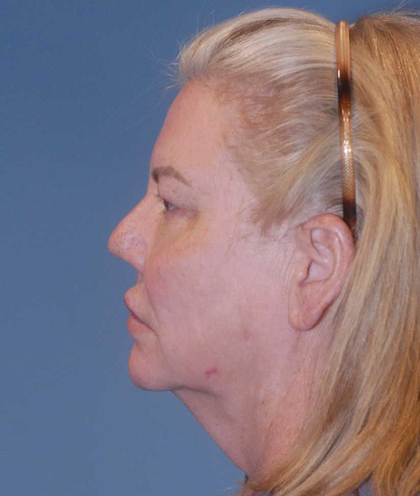 Rhinoplasty Before & After