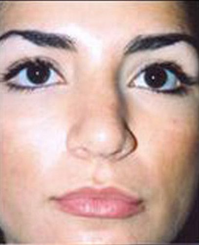 Rhinoplasty Before & After