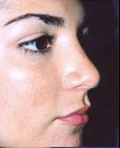 Rhinoplasty Before & After