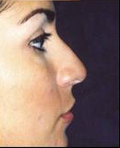 Rhinoplasty Before & After