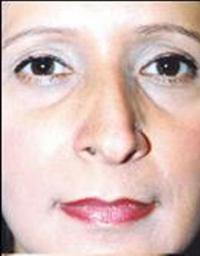 Rhinoplasty Before & After