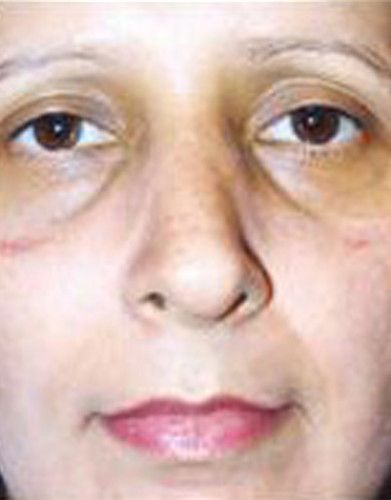 Rhinoplasty Before & After