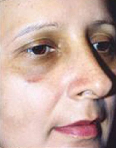 Rhinoplasty Before & After