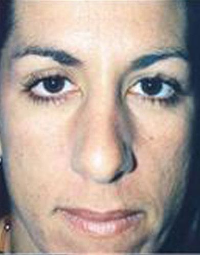 Rhinoplasty Before & After