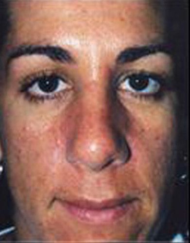 Rhinoplasty Before & After