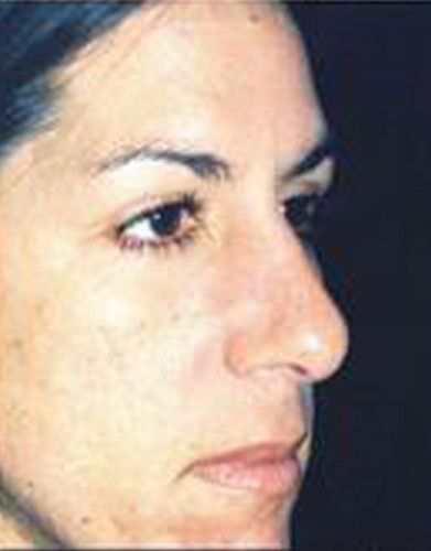 Rhinoplasty Before & After