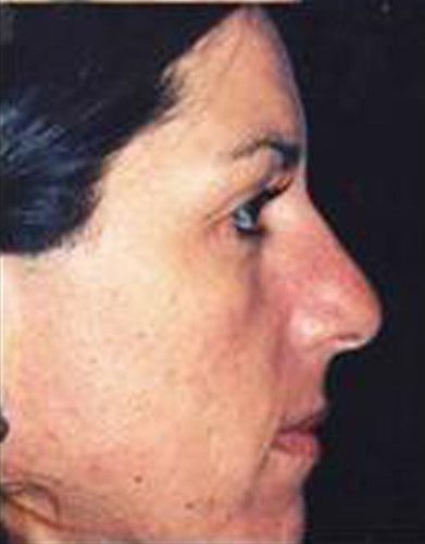 Rhinoplasty Before & After