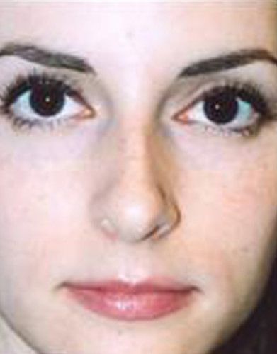 Rhinoplasty Before & After