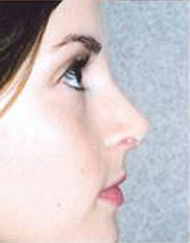 Rhinoplasty Before & After