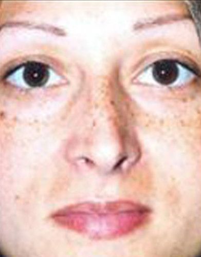 Rhinoplasty Before & After