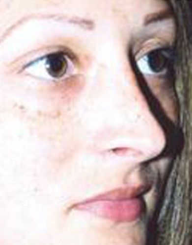 Rhinoplasty Before & After