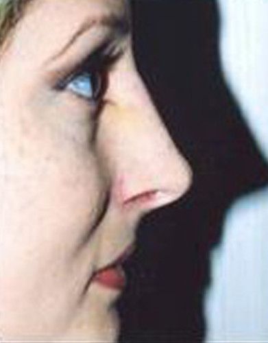 Rhinoplasty Before & After