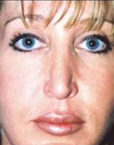 Rhinoplasty Before & After