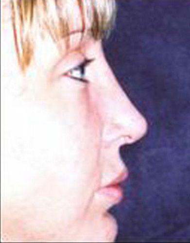 Rhinoplasty Before & After