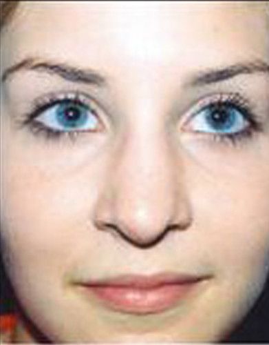 Rhinoplasty Before & After