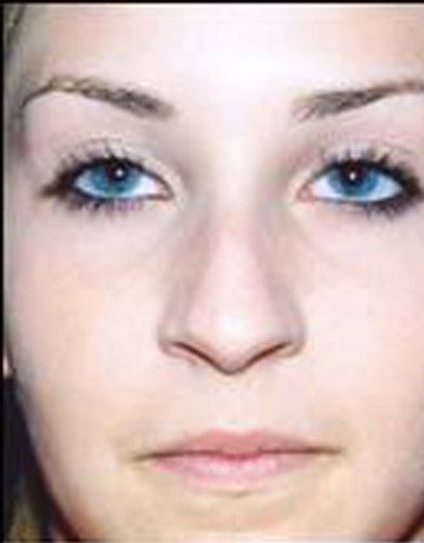 Rhinoplasty Before & After