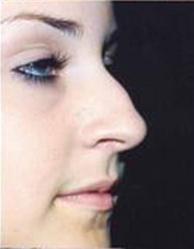 Rhinoplasty Before & After